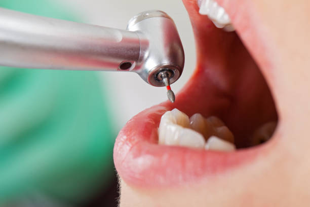 Best Emergency Wisdom Teeth Removal in Pratt, KS
